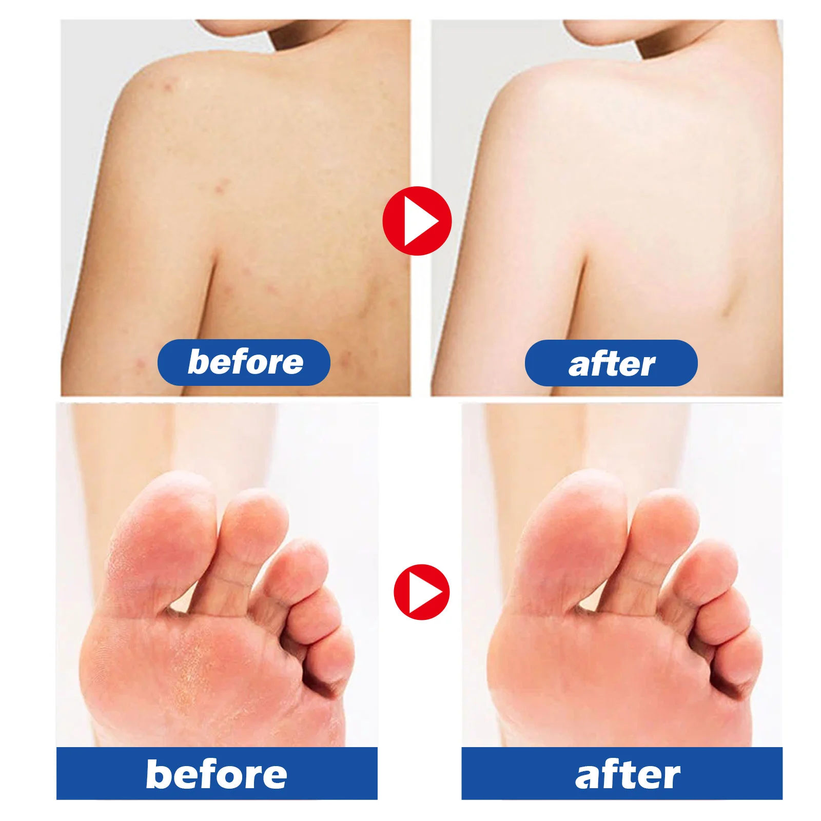 45% Urea Foot Cream 50g with 2% Salicylic Acid for Cracked Heels & Dry Skin Repair 7 45 urea foot cream 50g cracked heels repair cih af24uk8e desc 7
