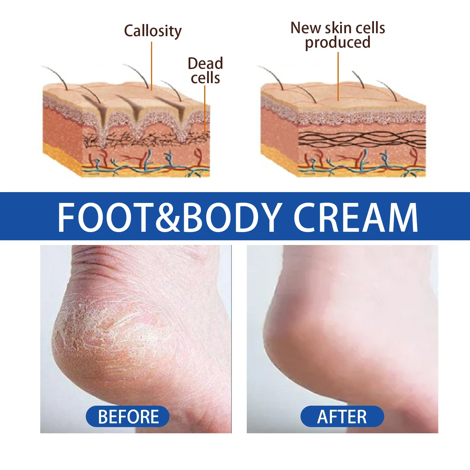 45% Urea Foot Cream 50g with 2% Salicylic Acid for Cracked Heels & Dry Skin Repair 9 45 urea foot cream 50g cracked heels repair cih af24uk8e desc 9
