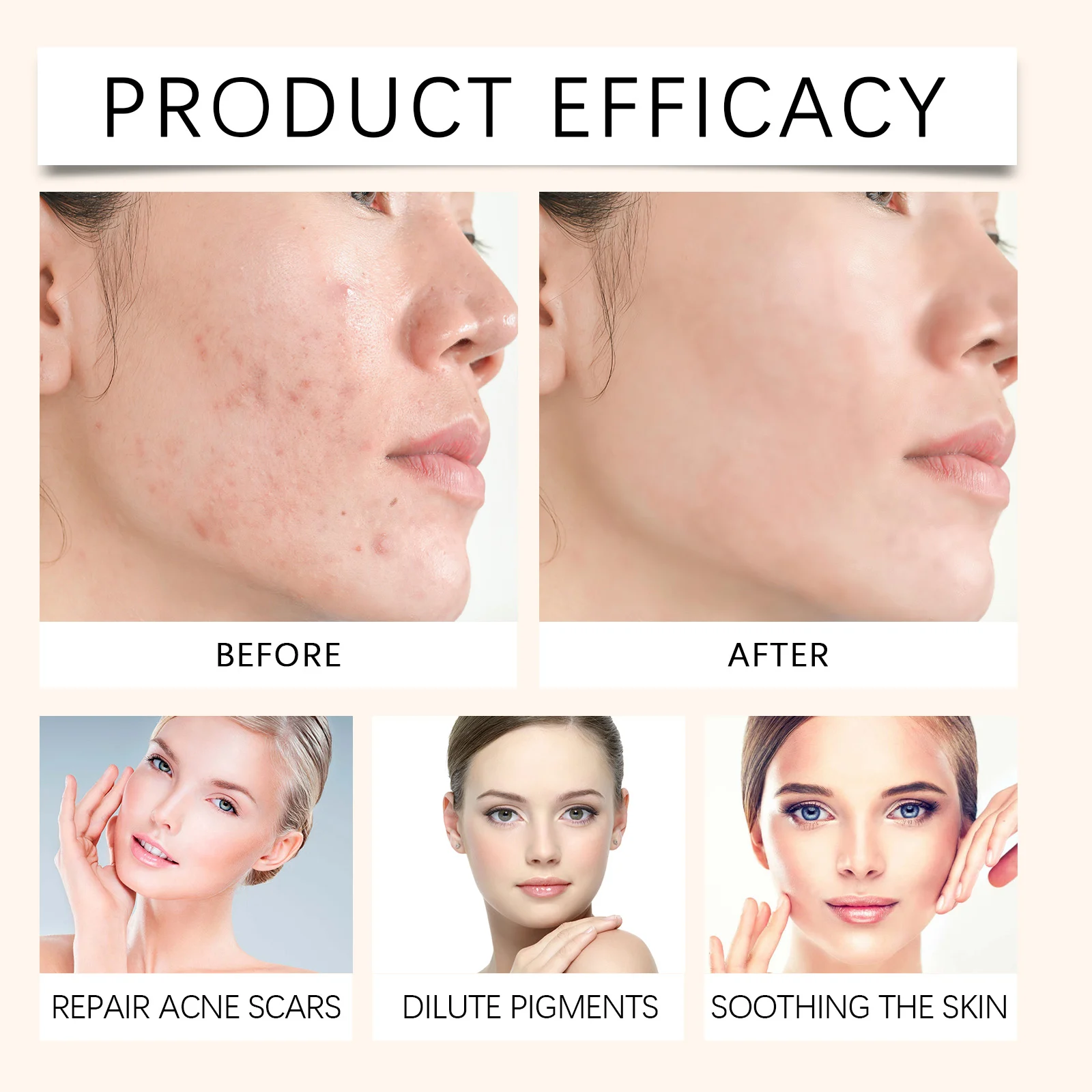 Acne Treatment Cream 50g with Salicylic Acid & Botanical Extracts for Soothing and Clearing Blemishes 12 acne treatment cream 50g salicylic acid der ypsaj4y2 desc 12