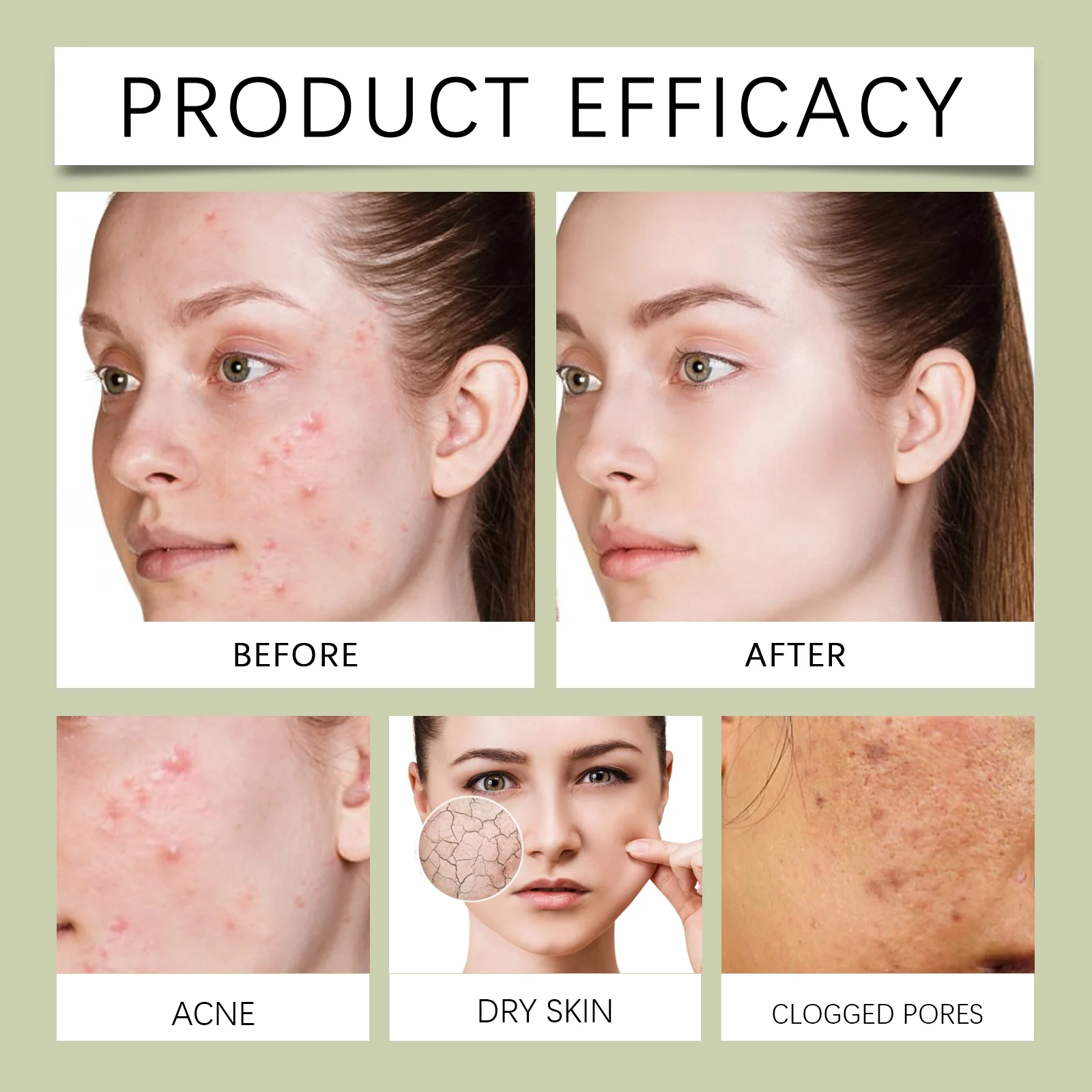 Anti-Acne Cream for Blemish-Prone Skin 15g with Tea Tree & Glycolic Acid 10 anti acne cream 15g tea tree glycolic acid der w9t8y3wr desc 10