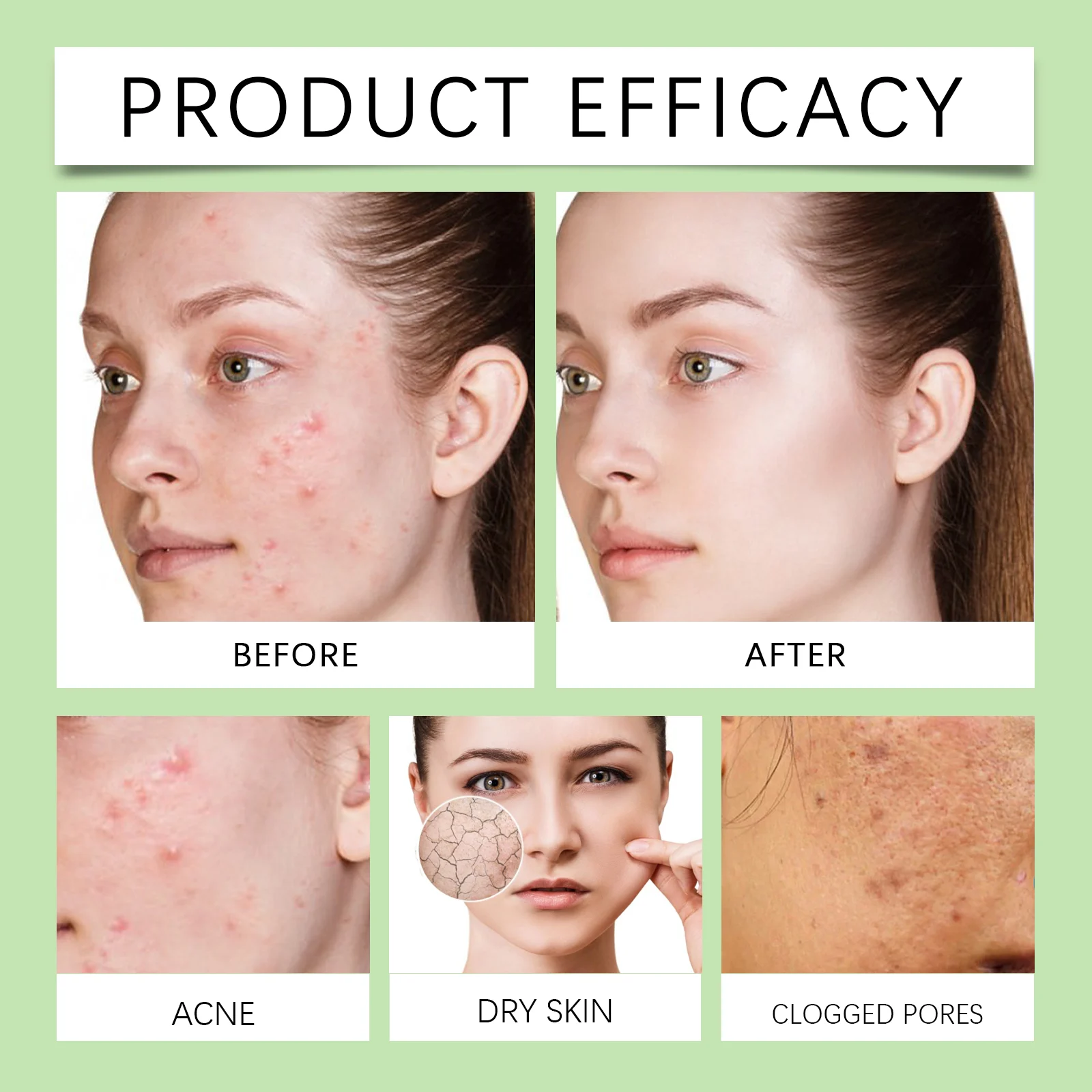 Azelaic Acid Acne Treatment Serum 30ml for Pore Minimizing & Scar Fading 12 azelaic acid acne treatment serum 30ml cih hvh92afr desc 12