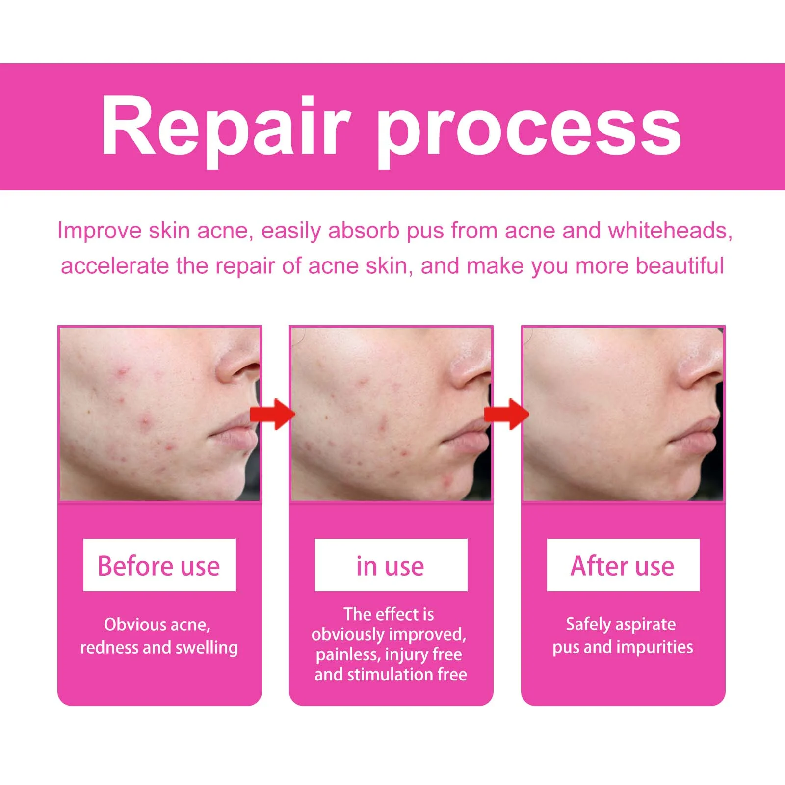 Butterfly Acne Patches 160 Patches Hydrocolloid Acne Spot Treatment 8 butterfly acne patches hydrocolloid 160 patches cih vn6gxh7a desc 8