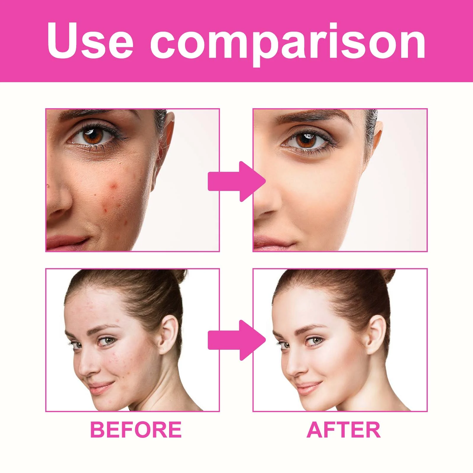 Butterfly Acne Patches 160 Patches Hydrocolloid Acne Spot Treatment 9 butterfly acne patches hydrocolloid 160 patches cih vn6gxh7a desc 9