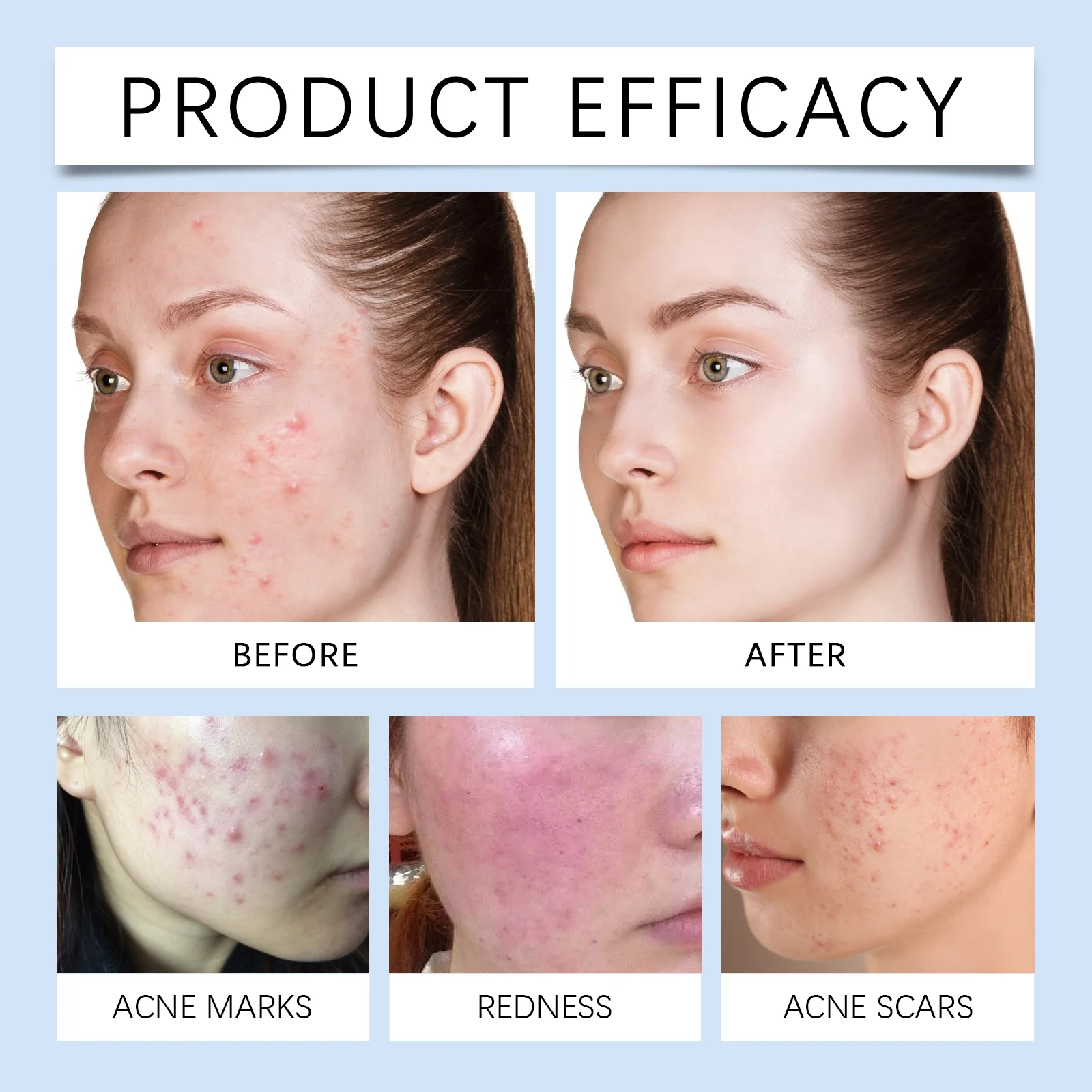 Cloud Pimple Patches for Acne Treatment, Ultra-Thin & Invisible Spot Healing Patches (35 Patches) 9 cloud pimple patches acne treatment invisible spot healing cih 8wjkmjm3 desc 9