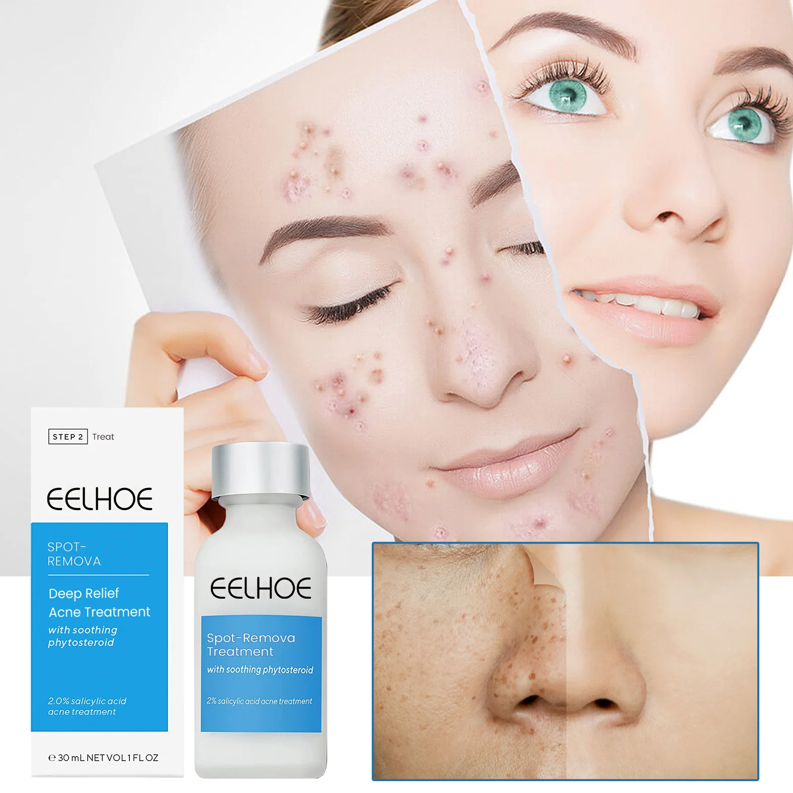 Dark Spot Remover Acne Treatment Lotion 30g for Fading Spots & Blemishes 2 dark spot remover acne treatment lotion 30g cih q2vepmnx desc 2