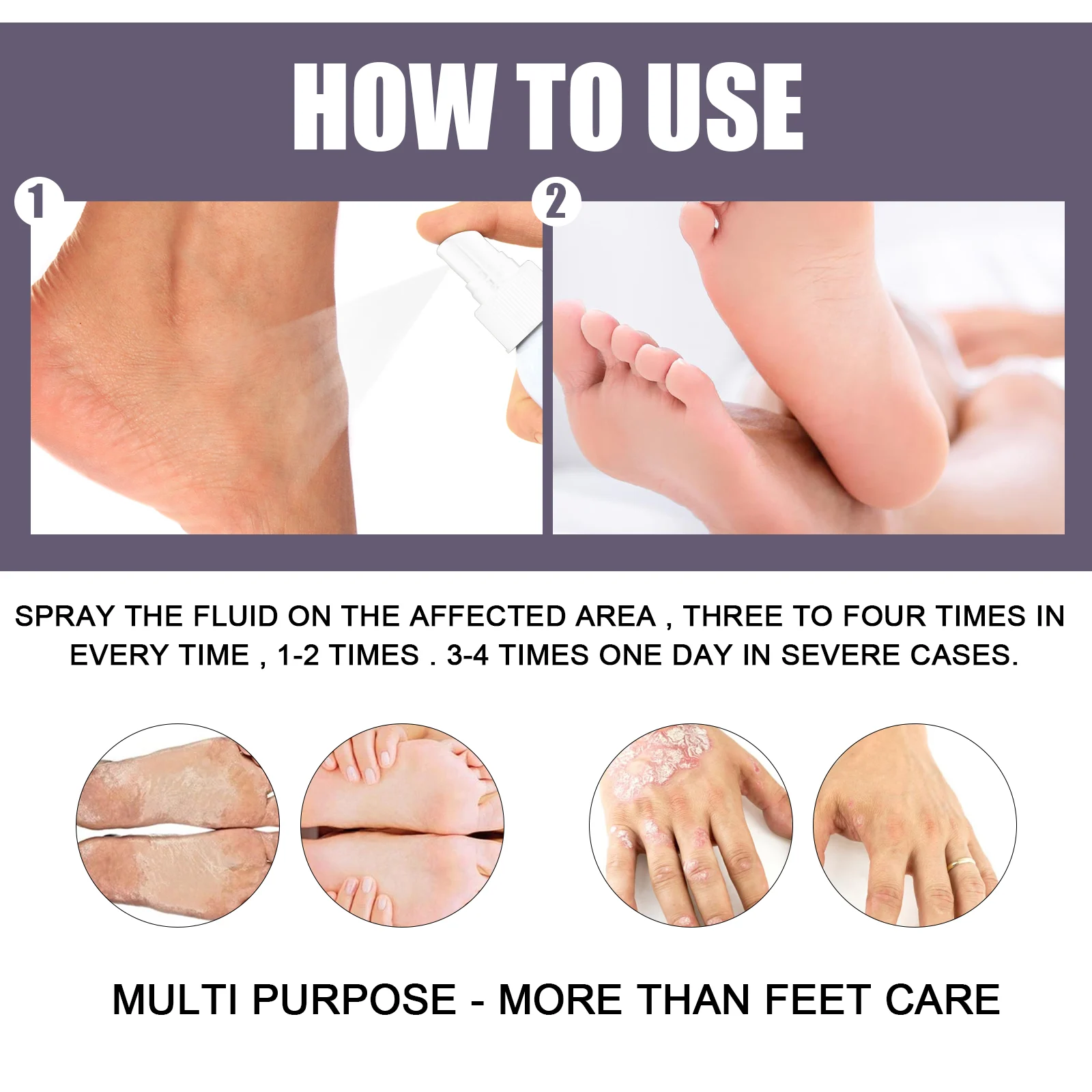 Eczema & Psoriasis Spray with Plant Ingredients Relieves Dry Itchy Skin 30ml 3 eczema psoriasis spray dry itchy skin relief 30ml cih a2rt7uqs desc 3