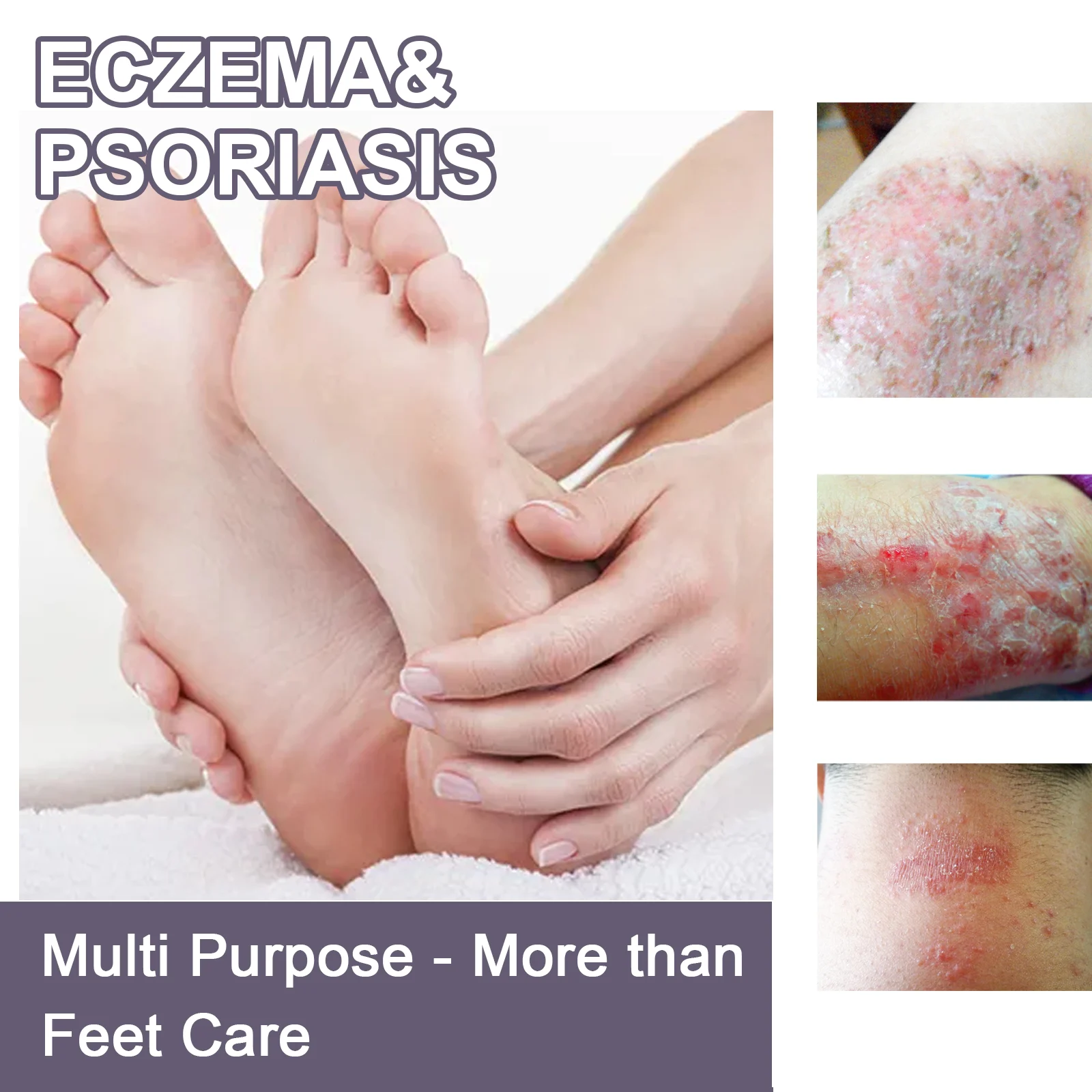 Eczema & Psoriasis Spray with Plant Ingredients Relieves Dry Itchy Skin 30ml 4 eczema psoriasis spray dry itchy skin relief 30ml cih a2rt7uqs desc 4