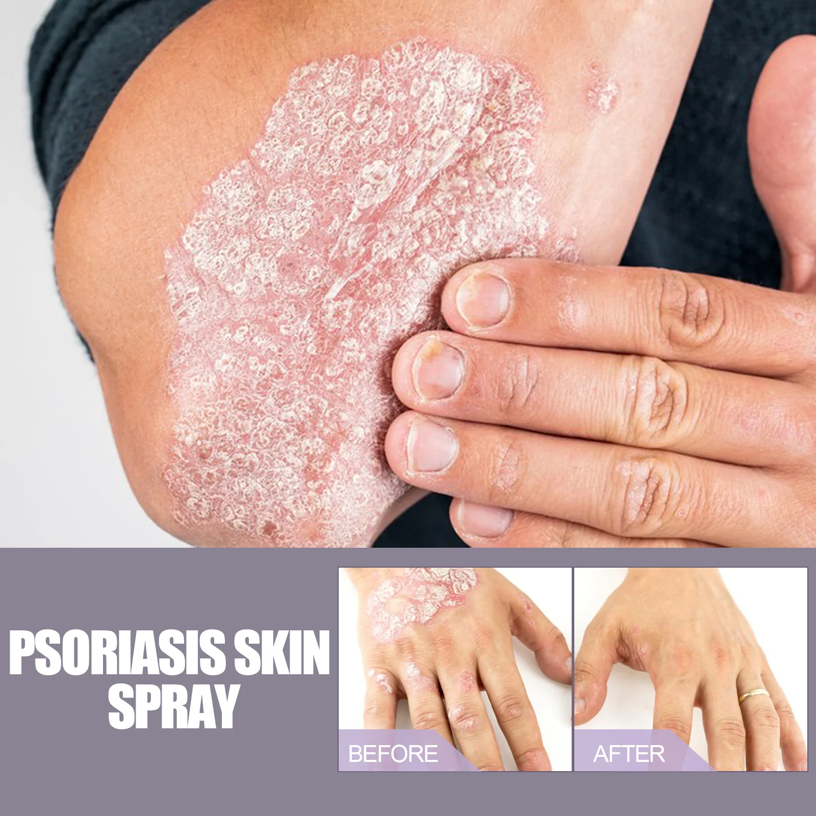 Eczema & Psoriasis Spray with Plant Ingredients Relieves Dry Itchy Skin 30ml 7 eczema psoriasis spray dry itchy skin relief 30ml cih a2rt7uqs desc 7