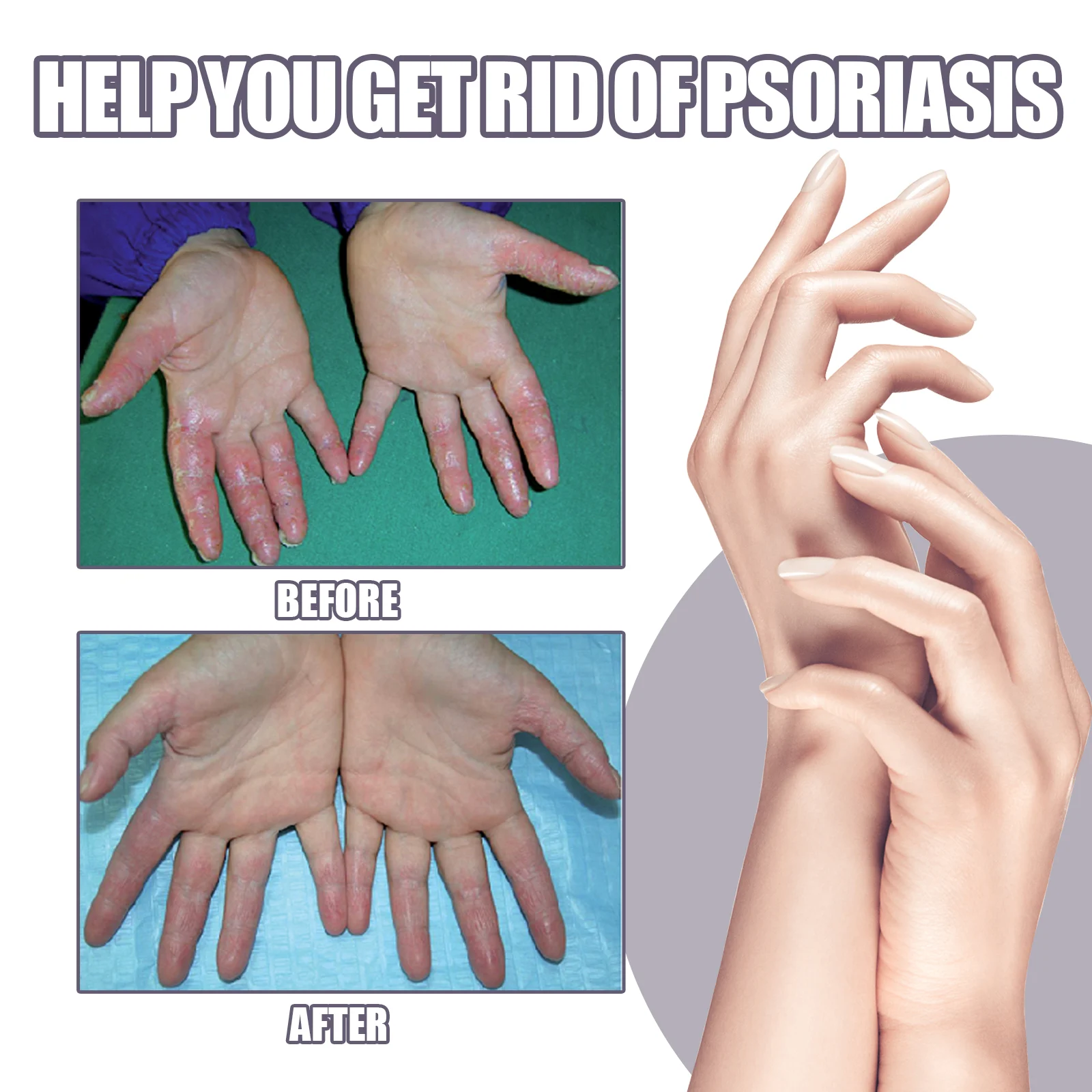 Eczema & Psoriasis Spray with Plant Ingredients Relieves Dry Itchy Skin 30ml 9 eczema psoriasis spray dry itchy skin relief 30ml cih a2rt7uqs desc 9