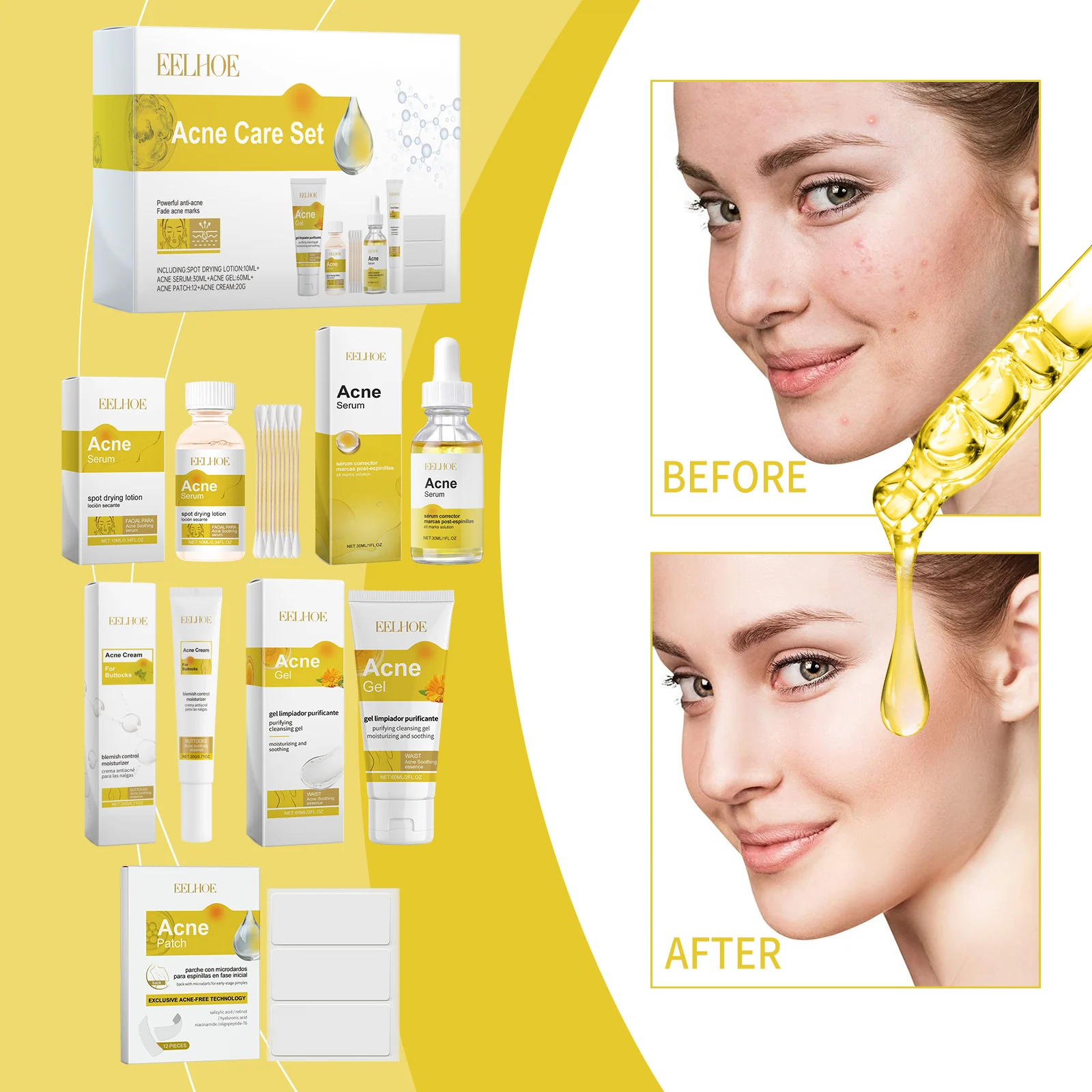 Acne Care Set for Face & Body with Salicylic Acid & Niacinamide - Complete Blemish Solution Kit 2 eelhoe acne care set complete blemish solution kit cih 4ve2q26k desc 2