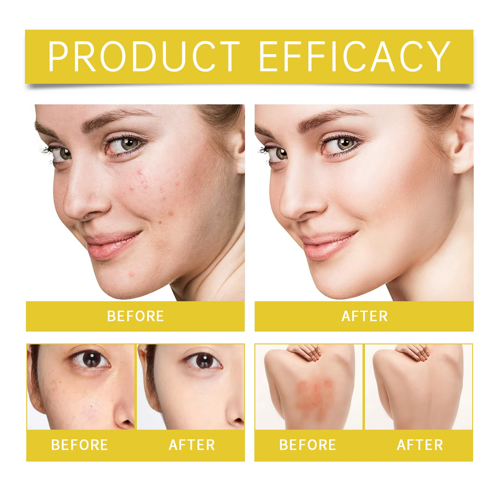 Acne Care Set for Face & Body with Salicylic Acid & Niacinamide - Complete Blemish Solution Kit 9 eelhoe acne care set complete blemish solution kit cih 4ve2q26k desc 9