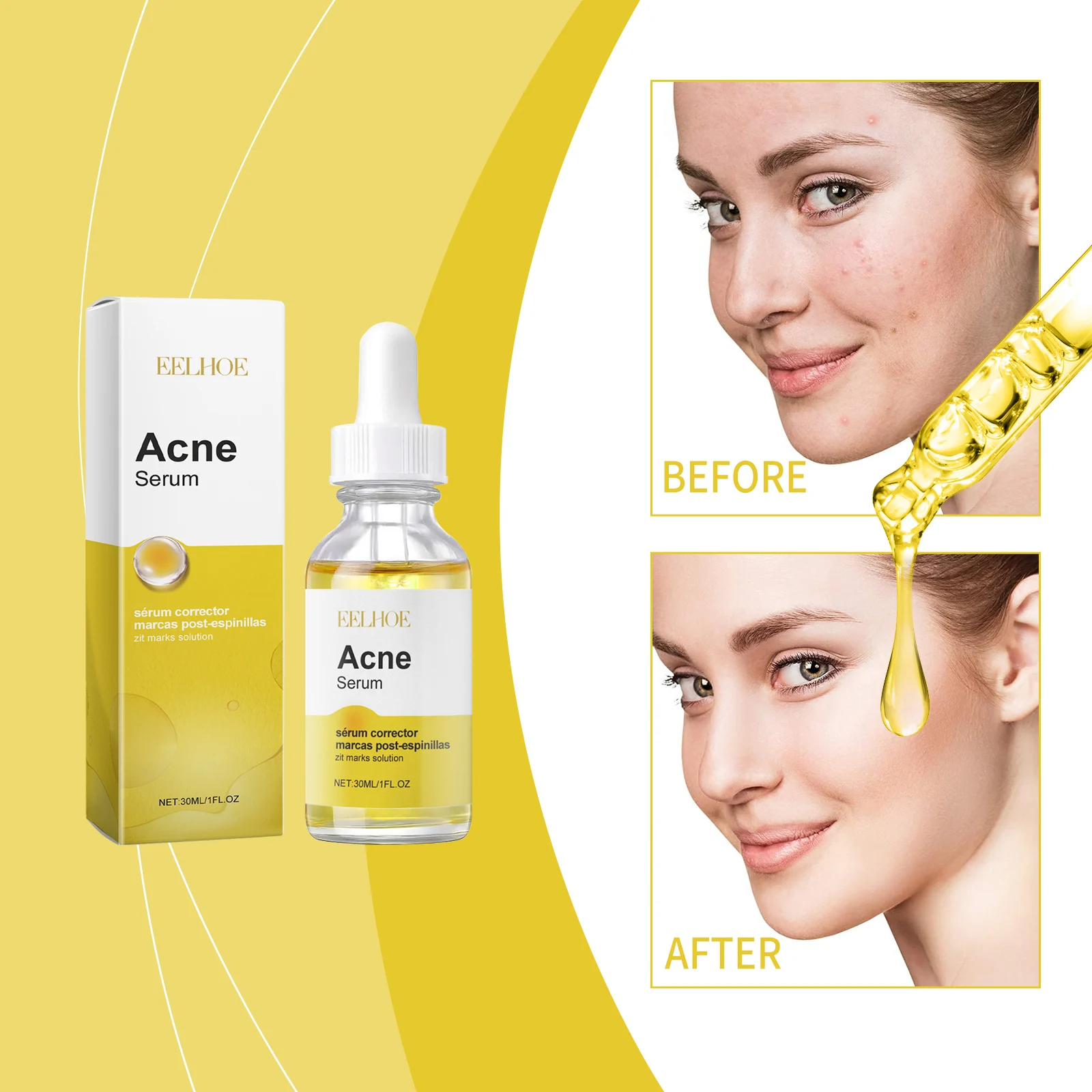 Acne Serum for Face 30ml - Repair Acne Marks, Control Oil, & Clear Skin 2 eelhoe acne serum 30ml cih k3ggm77t desc 2