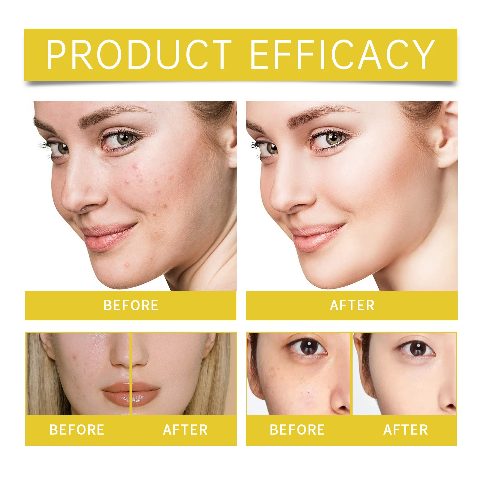 Acne Serum for Face 30ml - Repair Acne Marks, Control Oil, & Clear Skin 9 eelhoe acne serum 30ml cih k3ggm77t desc 9