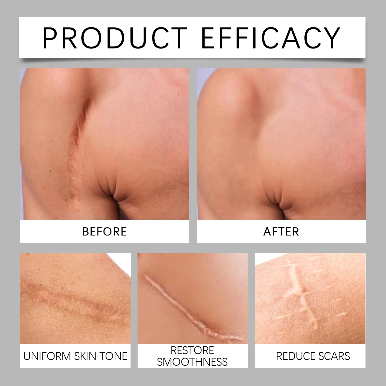 Scar Care Cream SPF 30 for Lightening Scars, Deep Moisturizing, and Skin Repair 12 eelhoe advanced scar care cream spf 30 10g der 4yeb757r desc 12