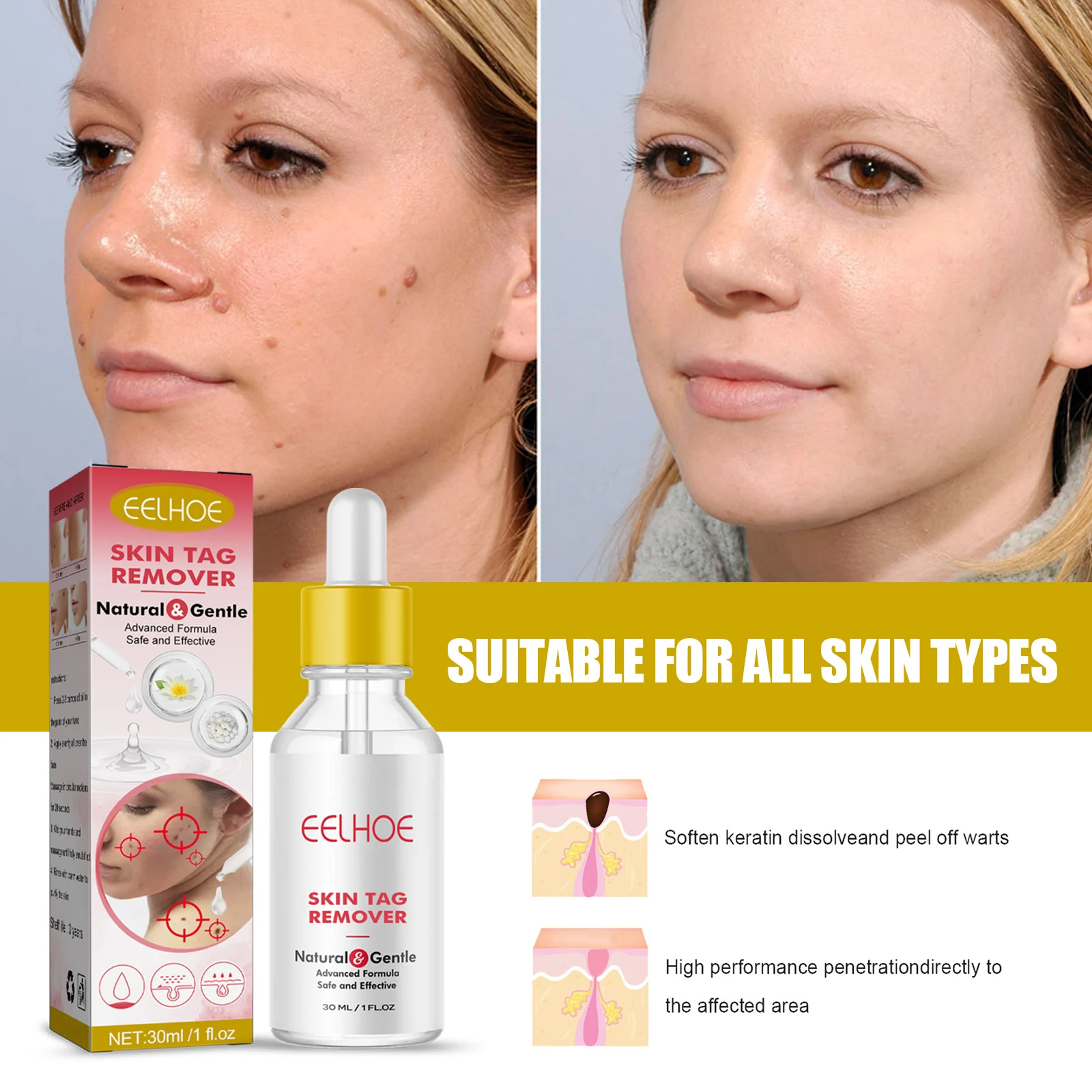 Skin Tag Remover Serum for Moles, Warts & Skin Tags, 30ml Gentle Formula 1 eelhoe skin tag remover serum 30ml cih 5bj39wx2 desc 1