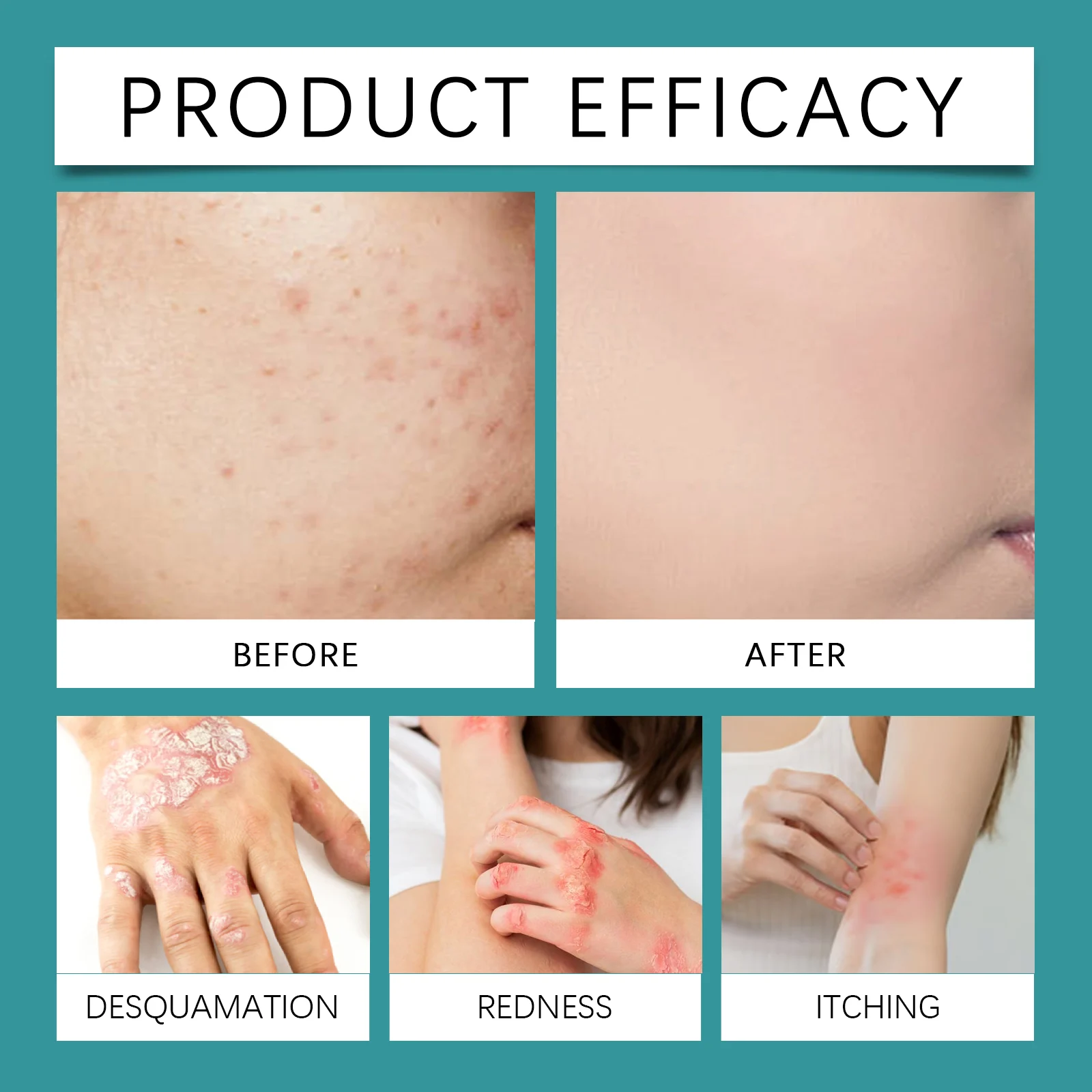 OceAura Folliculitis Relief Cream for Face, Scalp and Body - Soothes Skin 9 folliculitis relief cream cih bmqsb49r desc 9