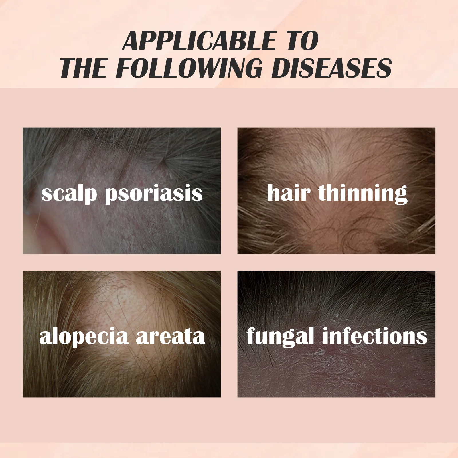 Hair Nourishing Essence Scalp Treatment for Dandruff Control & Psoriasis Relief 30ml 4 hair nourishing essence scalp treatment dandruff control psoriasis 30ml cih qv7pancq desc 4