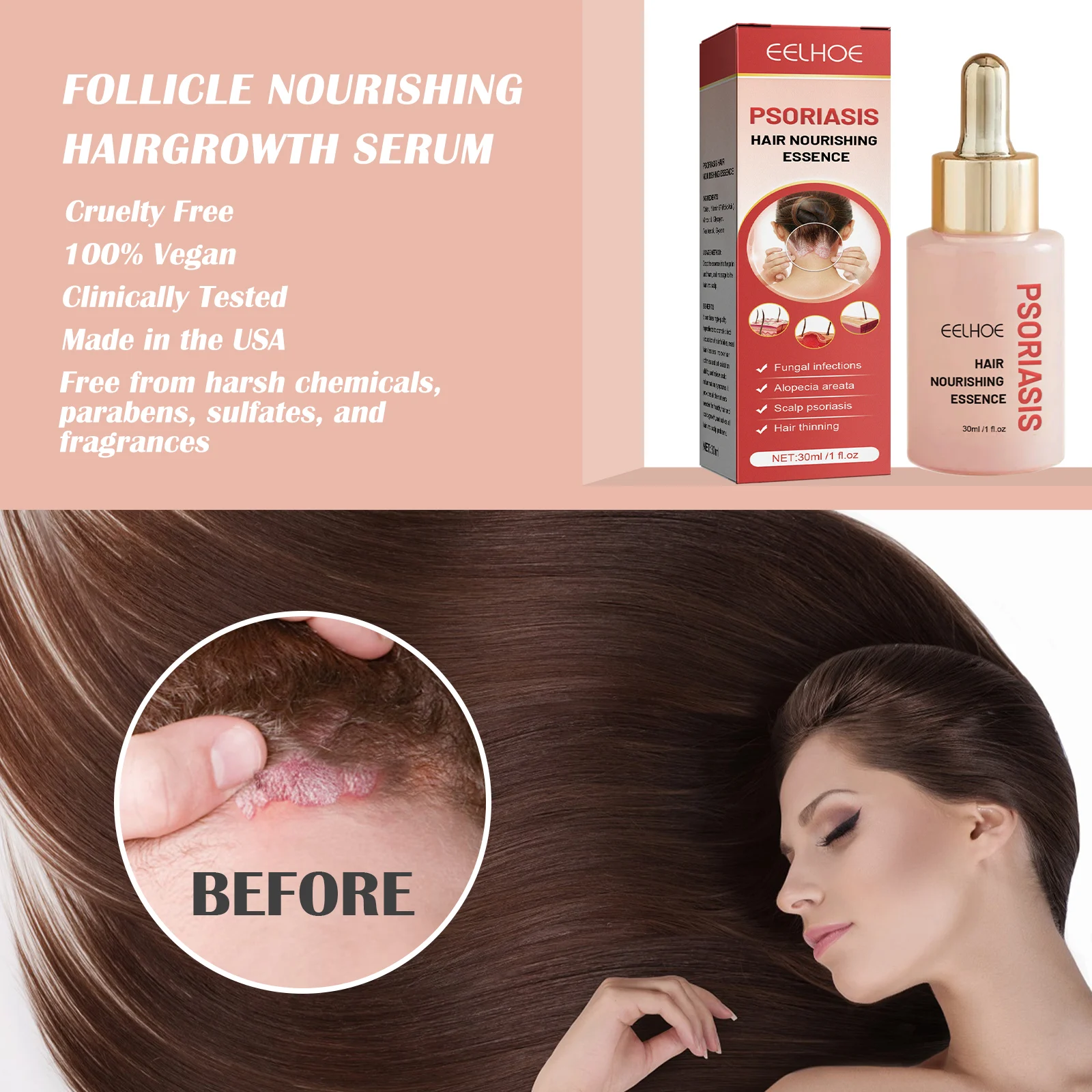 Hair Nourishing Essence Scalp Treatment for Dandruff Control & Psoriasis Relief 30ml 6 hair nourishing essence scalp treatment dandruff control psoriasis 30ml cih qv7pancq desc 6