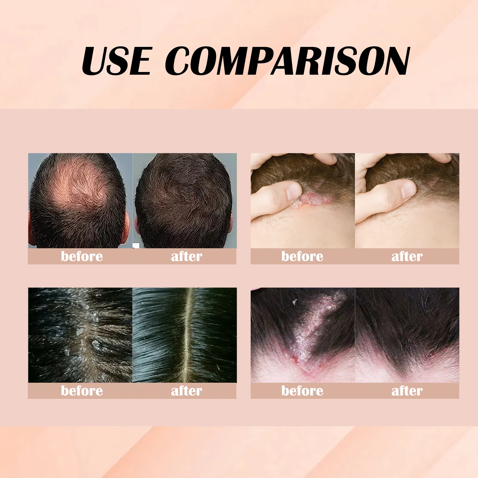 Hair Nourishing Essence Scalp Treatment for Dandruff Control & Psoriasis Relief 30ml 8 hair nourishing essence scalp treatment dandruff control psoriasis 30ml cih qv7pancq desc 8