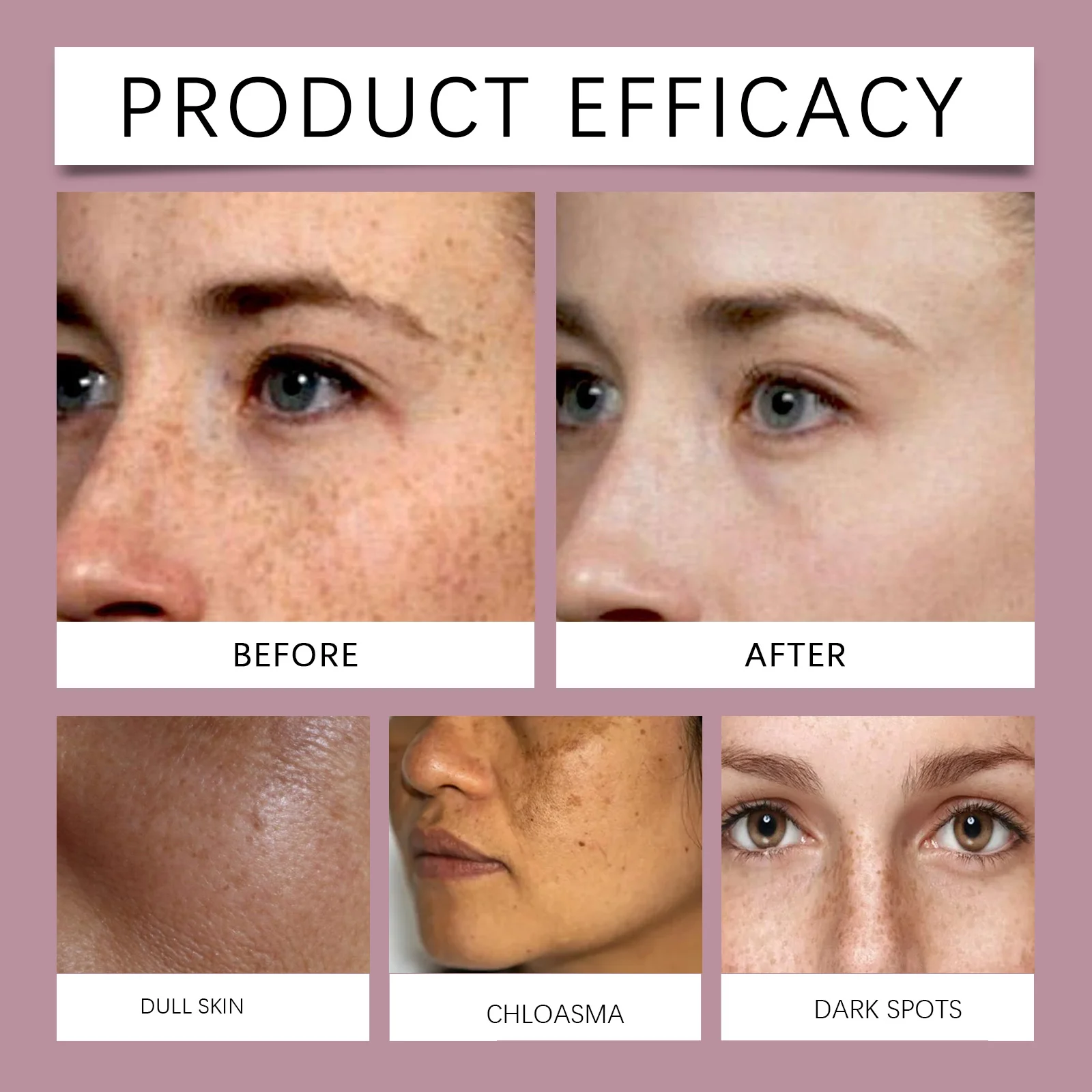 Melasma Spotless Concentrate TXA+Peptide Arbutin Dark Spot Removal Cream 15g 9 melasma spotless concentrate txa peptide arbutin dark spot removal cream 15g cih 9r4x6kc6 desc 9 1