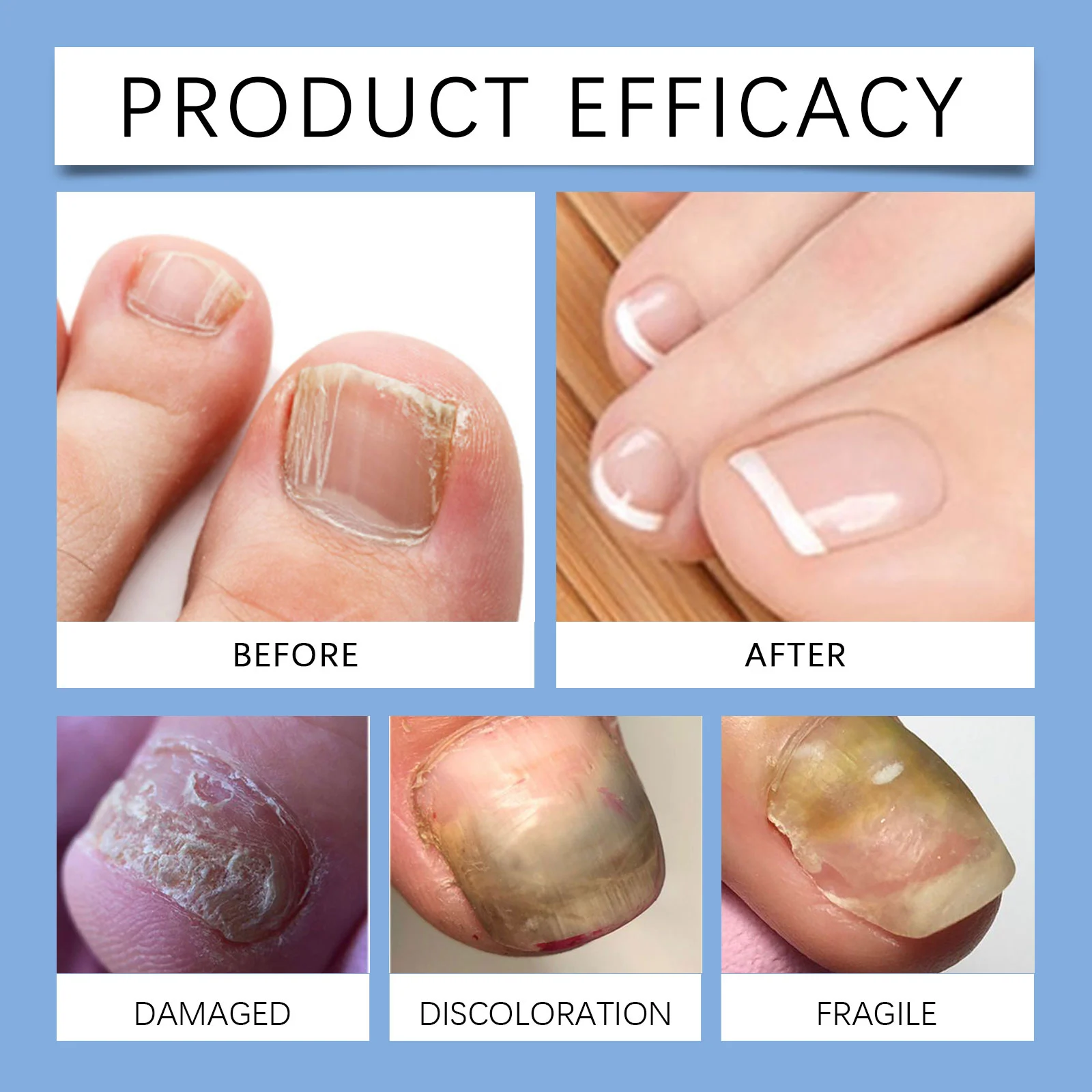 Nail Care Serum 20ml for Brittle & Peeling Nails with Urea & Hexanediol 12 nail care serum 20ml brittle peeling nails der pwhsz7ar desc 12