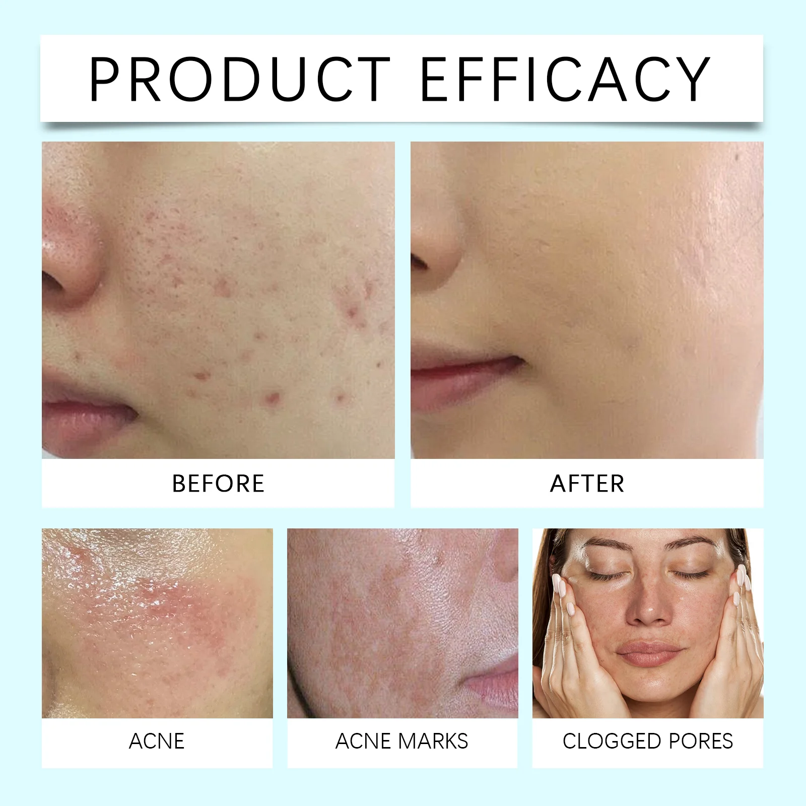 Niacinamide Acne Control Gel 20g Oil-Regulating Anti-Blemish Moisturizing Gel 9 niacinamide acne control gel 20g cih 5uauam2c desc 9