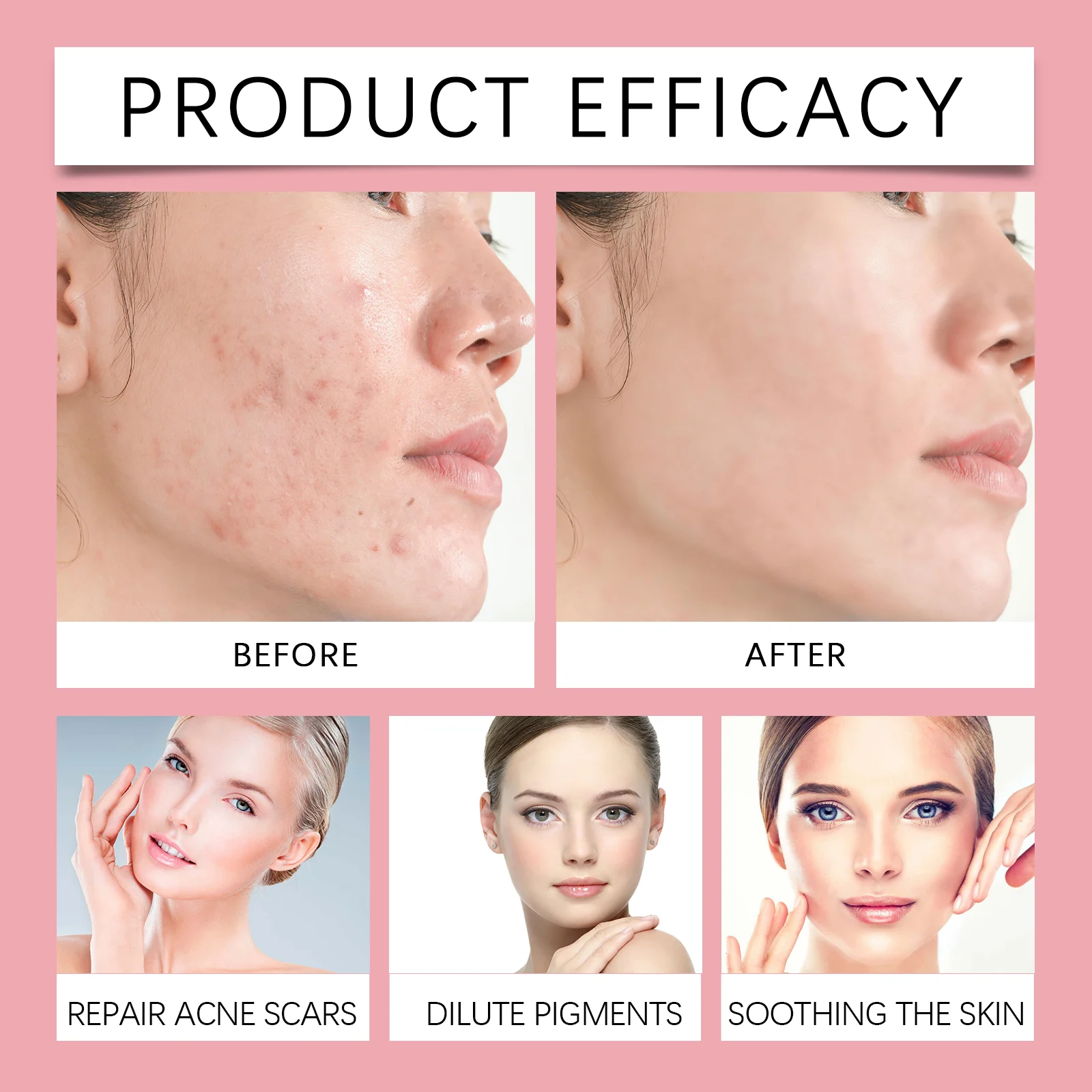 Niacinamide Anti-Acne Serum 50ml for Acne Scar Repair and Brightening 9 niacinamide anti acne serum 50ml cih 9agp5wbz desc 9