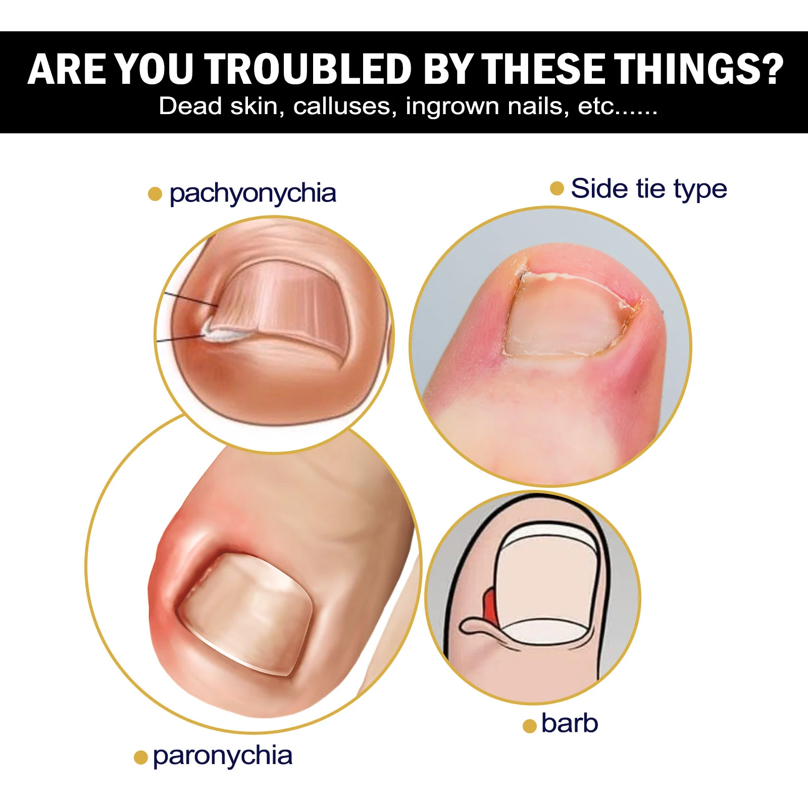 Paronychia Treatment Serum for Ingrown Toenails, Thickened & Fungal Nails - 73ml with Brush 5 paronychia treatment serum ingrown toenail fungal nail repair 73ml cih 462q693r desc 5