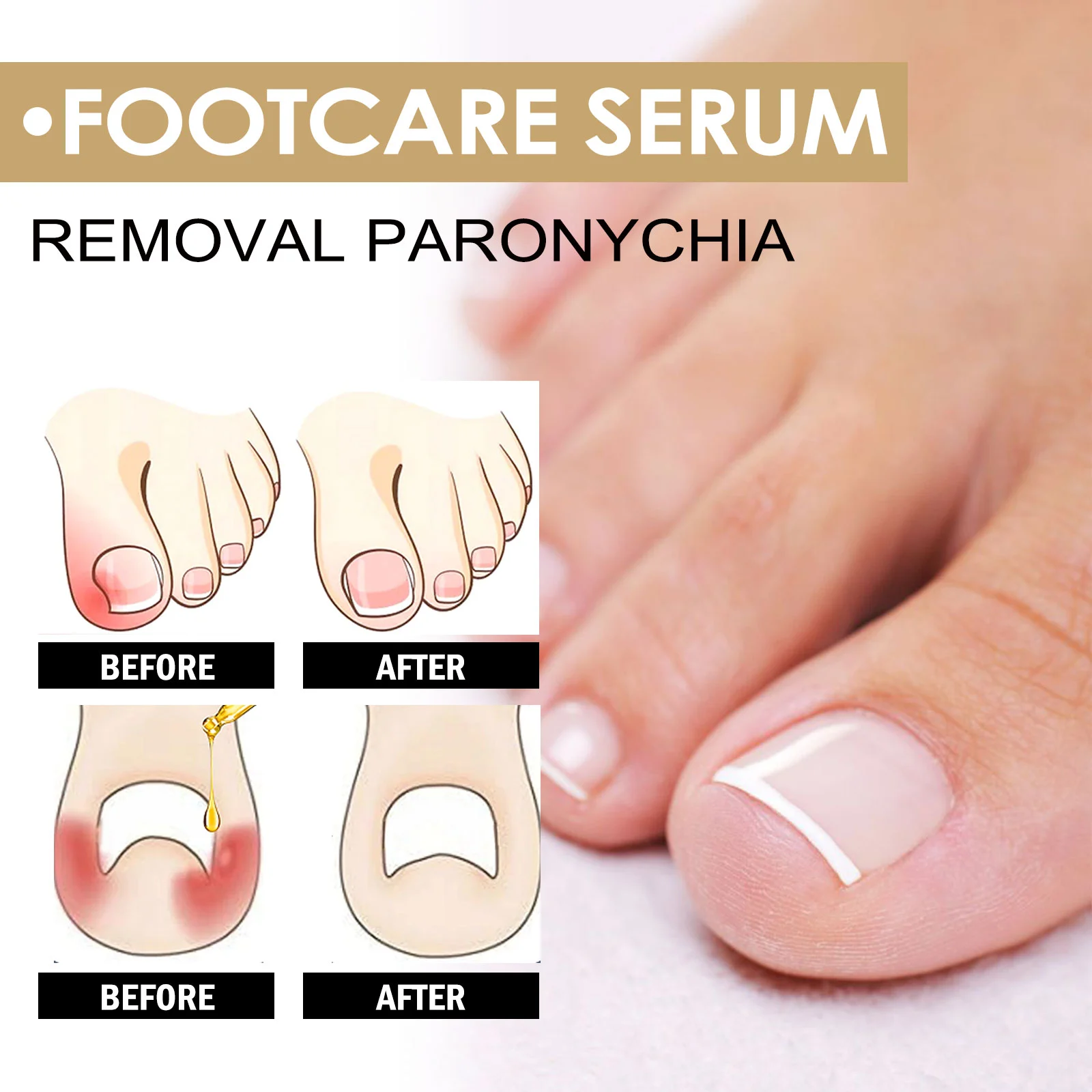 Paronychia Treatment Serum for Ingrown Toenails, Thickened & Fungal Nails - 73ml with Brush 7 paronychia treatment serum ingrown toenail fungal nail repair 73ml cih 462q693r desc 7
