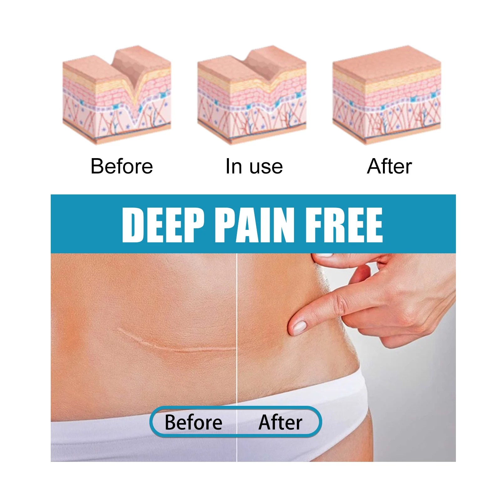 OUHOE Scar Repair Gel for Wounds, Sutures & Acne - Softens & Fades Scars, Improves Skin Tone 10 scar removal repair gel cih tp9v6a2w desc 10
