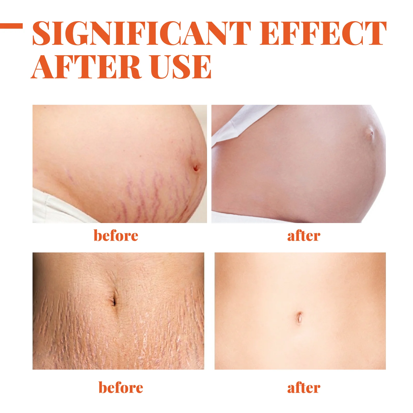 Stretch Mark Repairing Cream 50g - Intensive Moisturizing & Skin Elasticity Enhancer 9 stretch mark repairing cream 50g cih b54mcsb5 desc 9