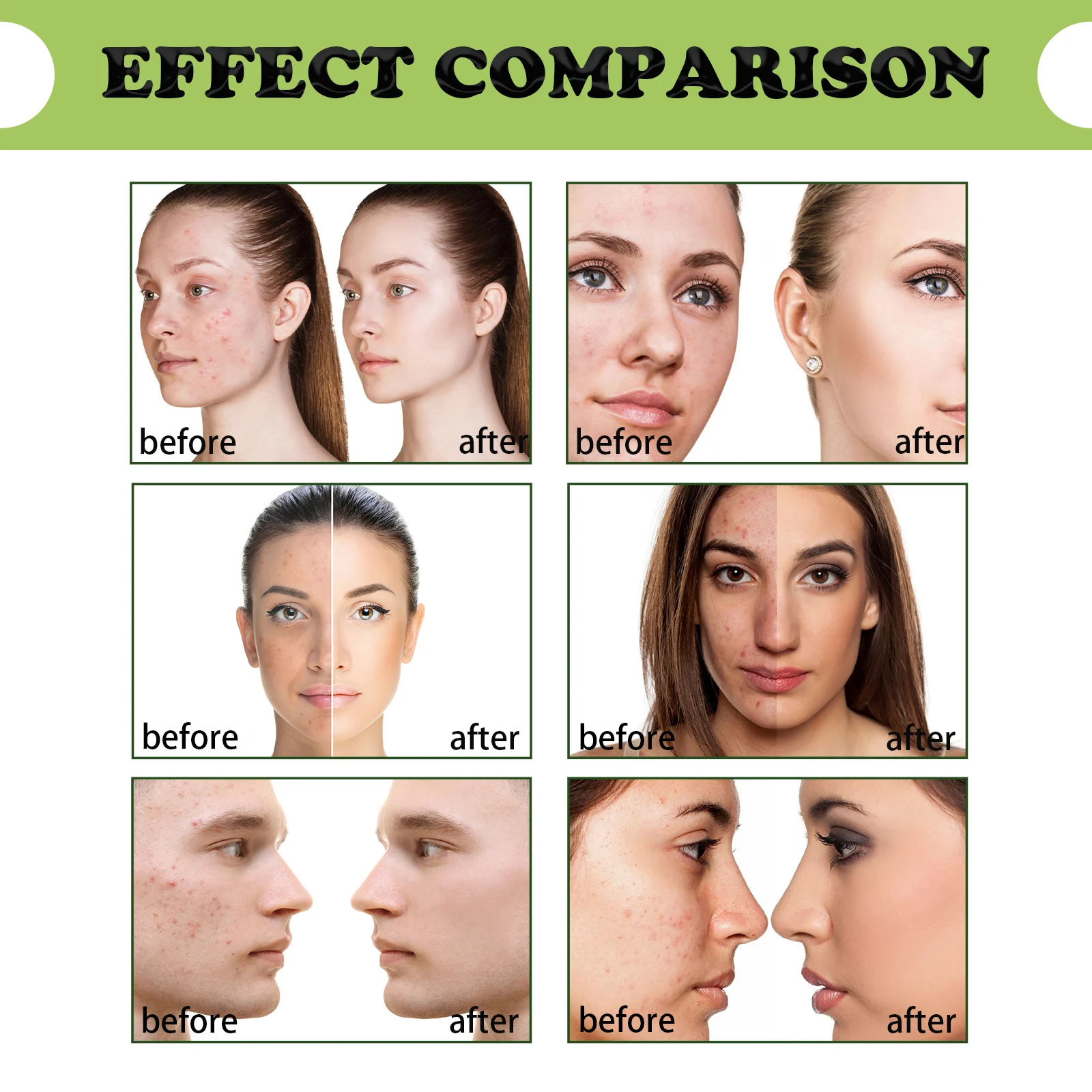 Tea Tree Acne Removal Serum 30ml Anti-Inflammatory Repair Blemish & Scar Treatment 9 tea tree acne removal serum 30ml cih 7g8thuju desc 9