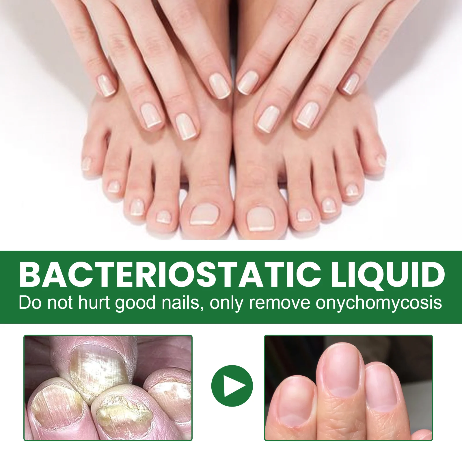 Toenail Fungus Repair Solution for Thickened, Discolored, and Peeling Nails 7 toenail fungus repair solution 20ml cih 9gwzqqy5 desc 7
