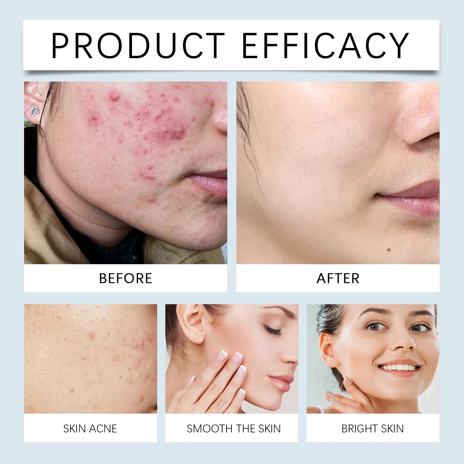 Acne Control Soothing Repair Lotion for Oily Skin, Reduces Blemishes & Blackheads, 30ml 9 viareline acne control soothing repair lotion 30ml cih kq7ja6ct desc 9